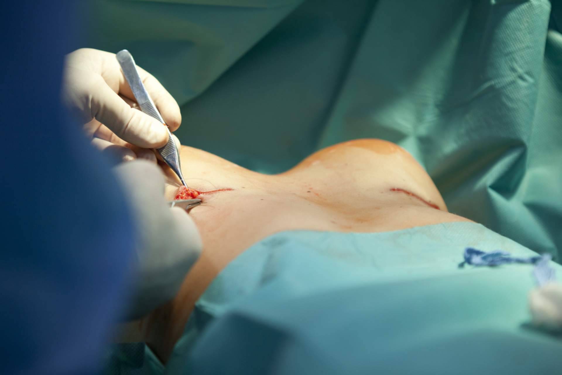A2Clinic contribuye a mejorar la calidad de vida con la cirugía de reducción de pecho