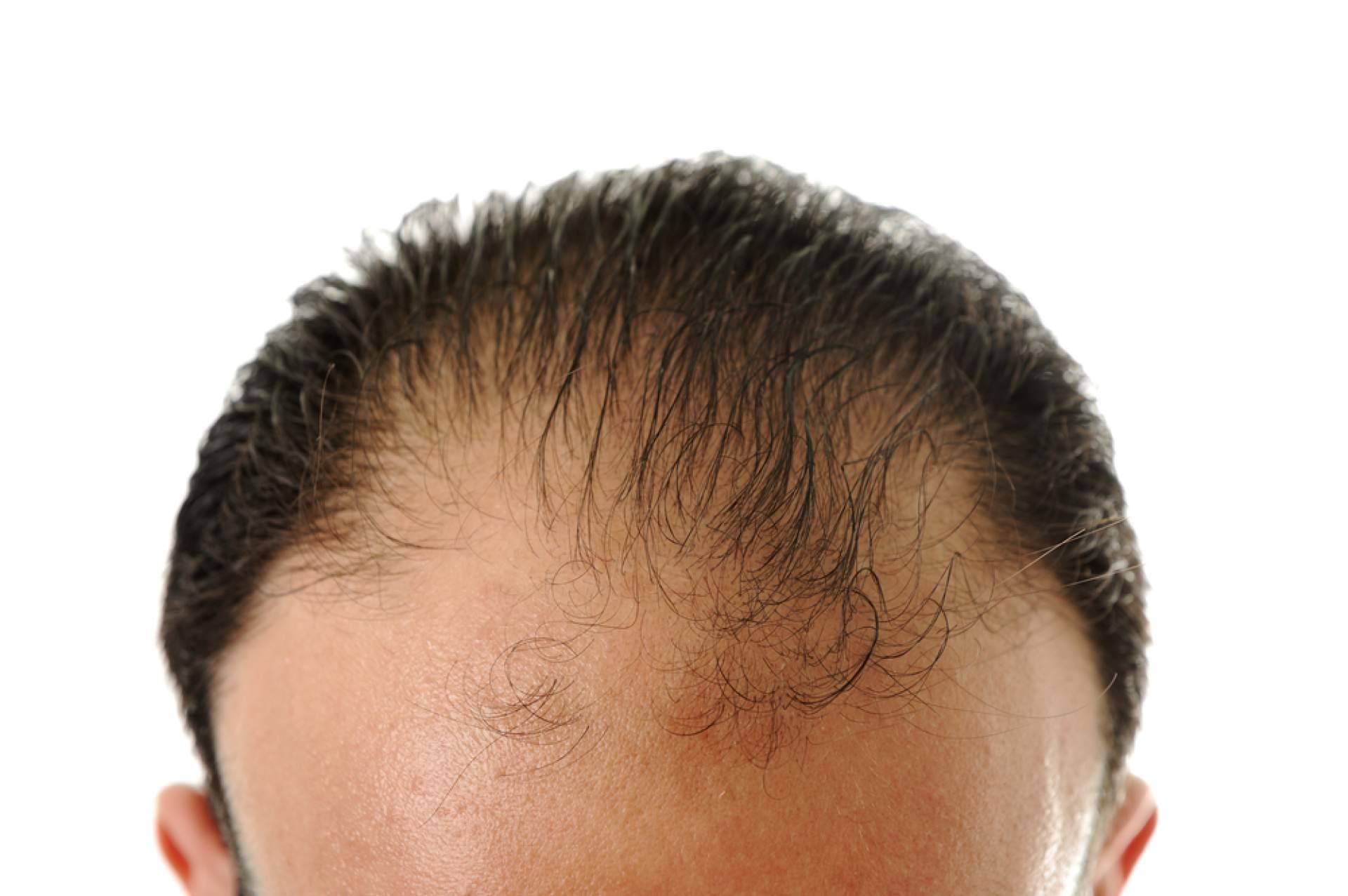 El cuidado post trasplante capilar protagoniza la oferta especializada de HairFluencer
