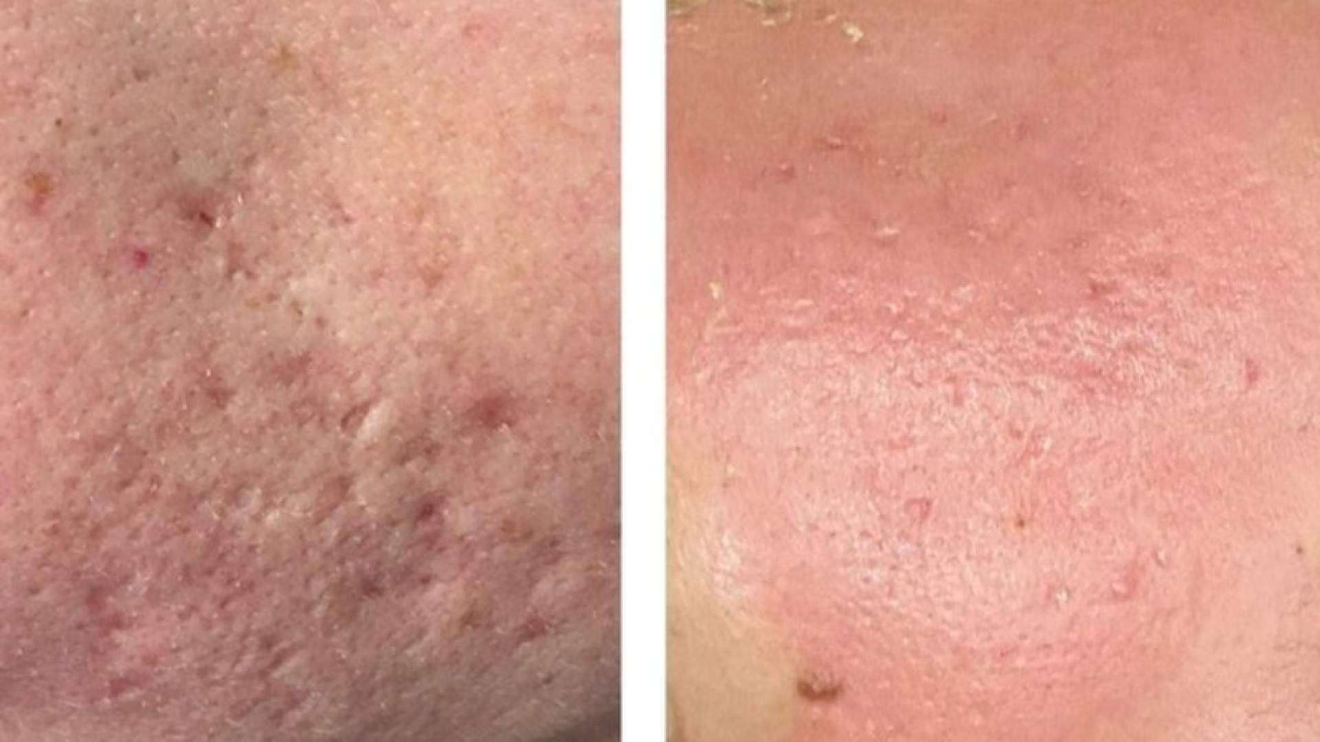 Cicatrices de acné; RegenElit Clinic trae a Barcelona un protocolo de medicina regenerativa